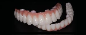 full-arch-zirconia-implant-