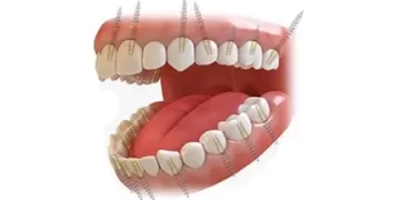 Cost of Full Mouth Dental Implants in Vadodara India